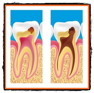 Metode de prevenire a cariei dentare